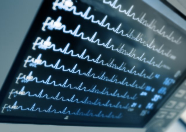 Medizinischer Monitor mit dargestellten Herzkurven und Vitaldaten